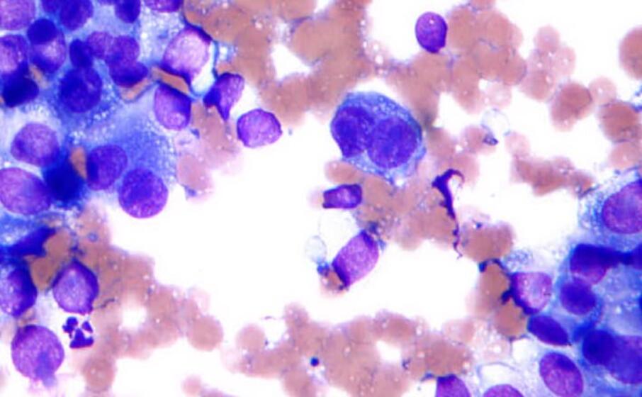 melanoma immagine simbolo (foto da wikimedia)