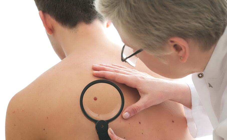 un dermatologo controlla un neo