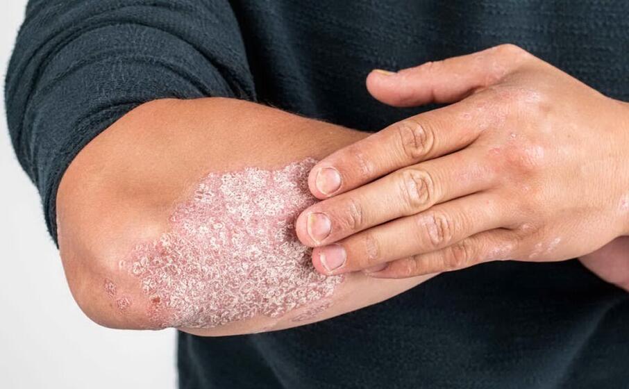 la psoriasi trascurata pu aggravarsi notevolmente
