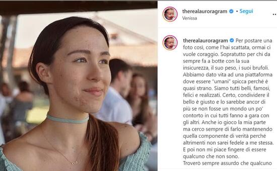 Aurora Ramazzotti And The Photo With Pimples Hunziker You Are Beautiful And Brave Archyworldys