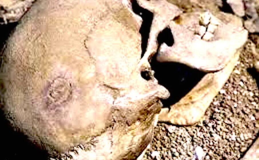 il particolare del cranio si vede il cerchio perfettamente cicatrizzato