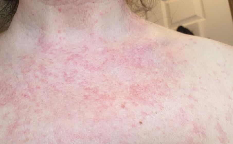 I segni del Covid sulla pelle il 21 dei malati ha eruzioni cutanee